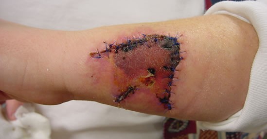 Dog Bites